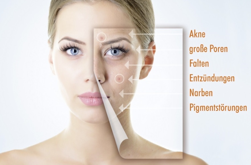 anti aging bei einer frau mit mikroderabrasion